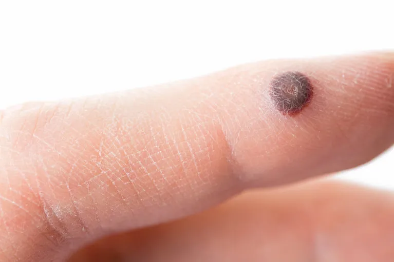 いぼ･たこ･ウオノメ